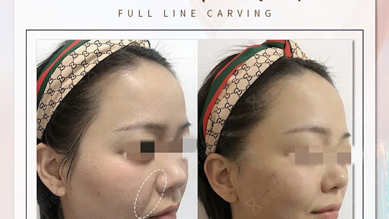 埋线提升后线头外露怎么办？揭秘正确处理方法