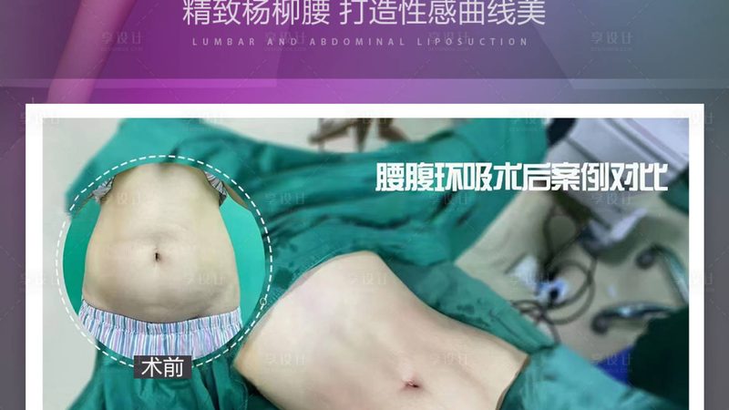 小标题：平价双眼皮消肿好物推荐