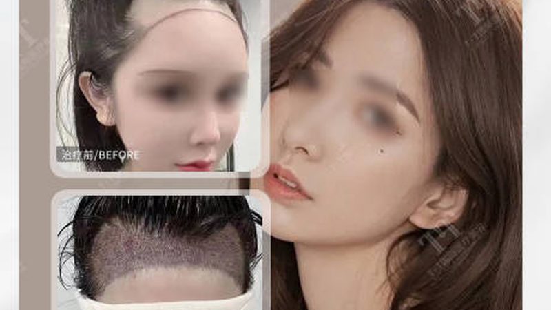 激光与光子嫩肤：揭秘两种美肤技术的内在差异
