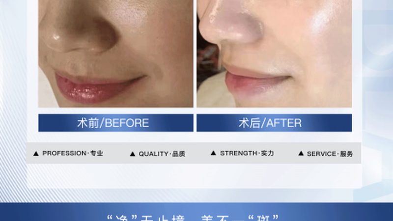 如何查询隆鼻假体品牌授权？揭秘选购过程中的关键要点