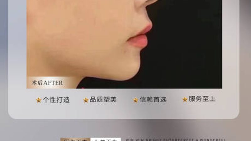 玻尿酸填充脸颊：揭秘完整流程步骤