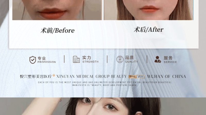 自体脂肪和玻尿酸哪个适合唇珠填充