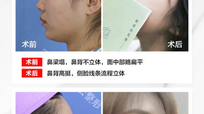 激光美容后防晒最佳方法