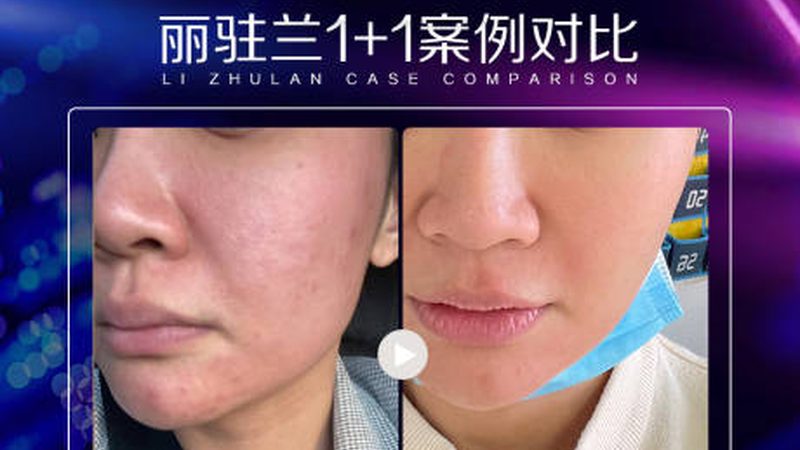 医美仪器厂家哪家好