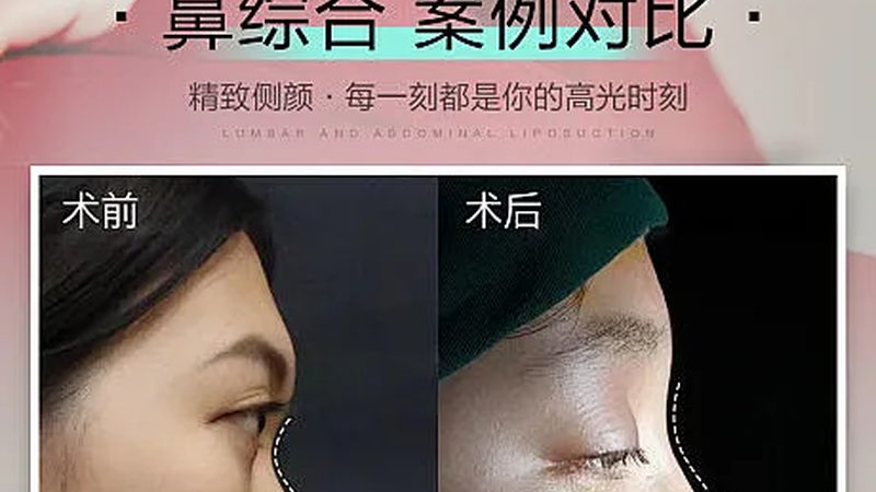 北京下颌角截骨失败修复，揭秘价格背后的真相
